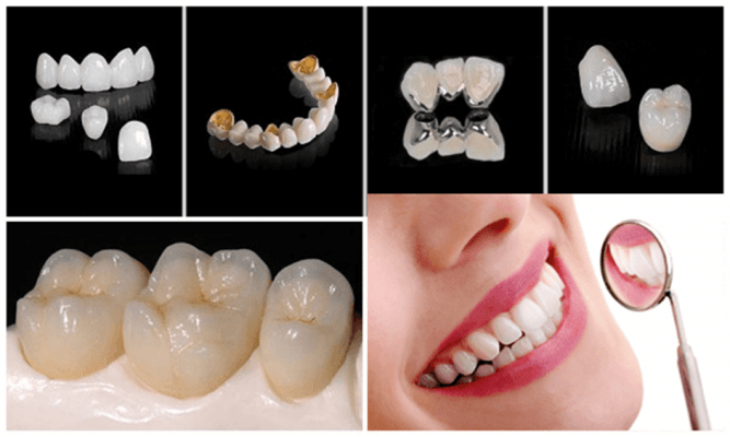 Răng giả được chăm sóc tương tự như răng thật