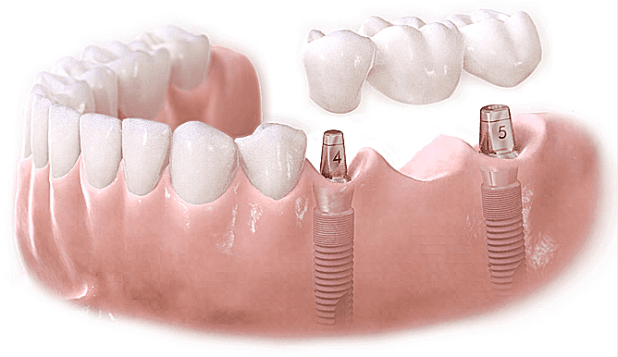 Công nghệ trồng răng Implant