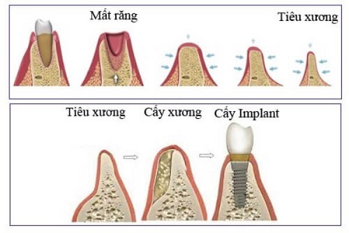 Trồng răng Implant giúp giữ vững mô xương hàm