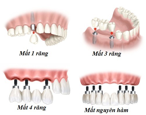 Trồng răng Implant khôi phục lại cho tất cả các trường hợp mất răng khác nhau
