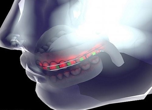 Hình thức niềng răng bằng tia LED